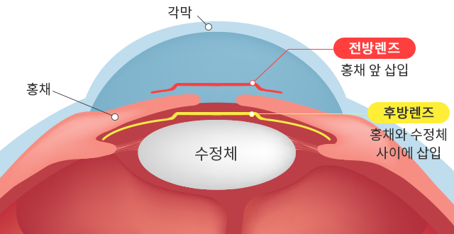 렌즈삽입술이란