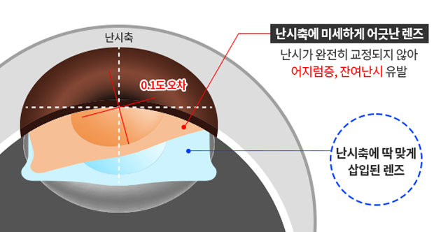 난시축에 맞춰 정확하게 삽입