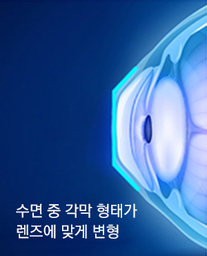 드림렌즈착용후