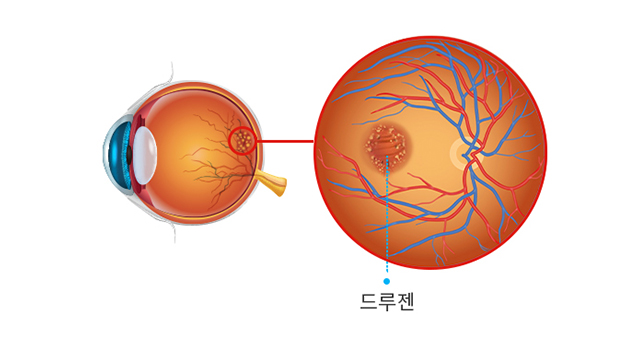 비삼출성 건성 황반변성