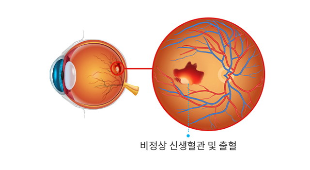 삼출성 습성 황반변성