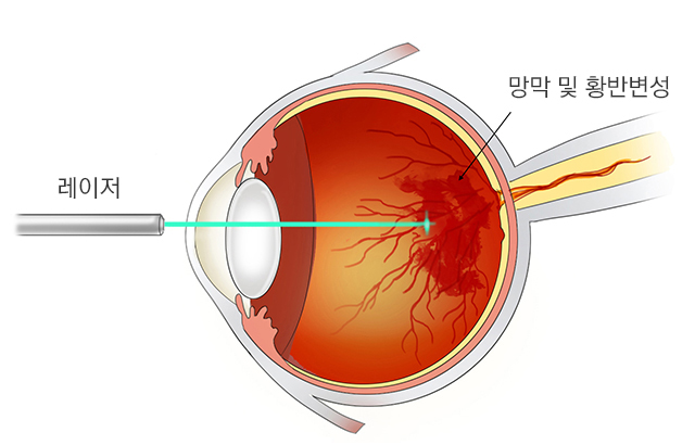 광역학레이저치료(PDT)