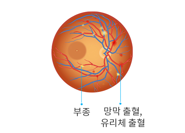 비증식 당뇨망막병증