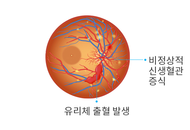 증식 당뇨망막병증