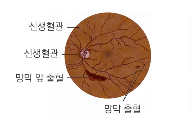 범망막레이저광응고술