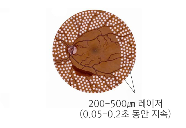 범망막레이저광응고술